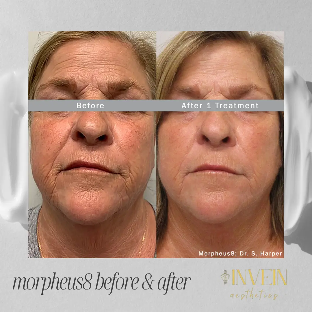 Before and After | Morpeus8 Treatment by Invein Aesthetics in Baltimore MD