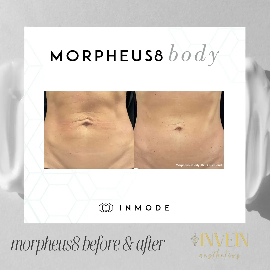 Before and After | Morpeus8 Treatment by Invein Aesthetics in Baltimore MD