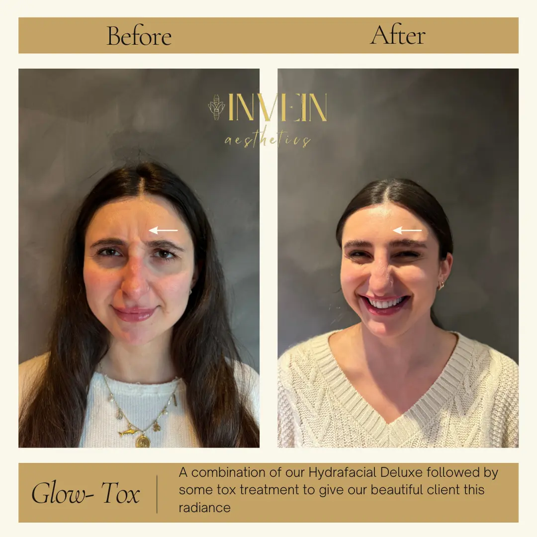 Before and After | Hydrafacial Treatment by Invein Aesthetics in Baltimore MD