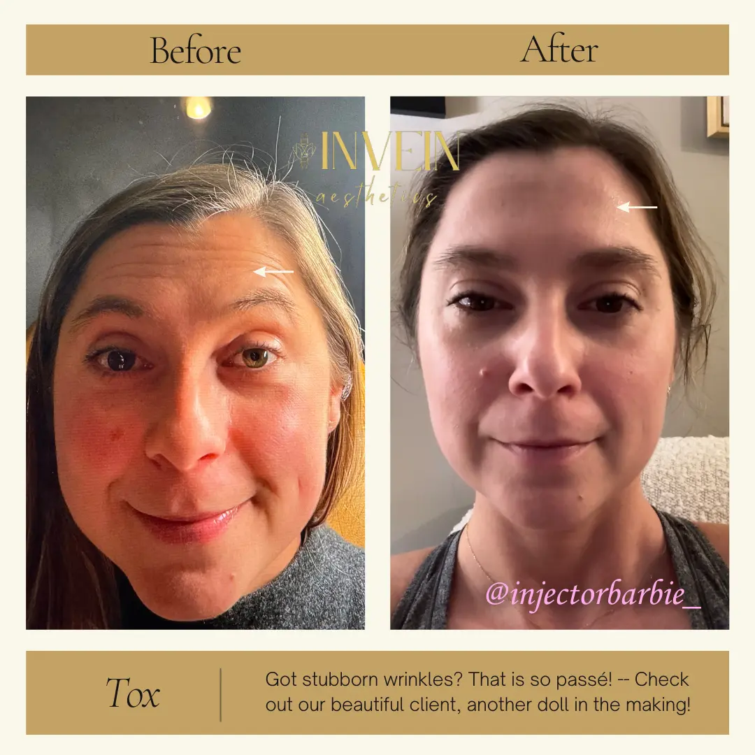 Before and After | Wrinkle Treatment by Invein Aesthetics in Baltimore MD