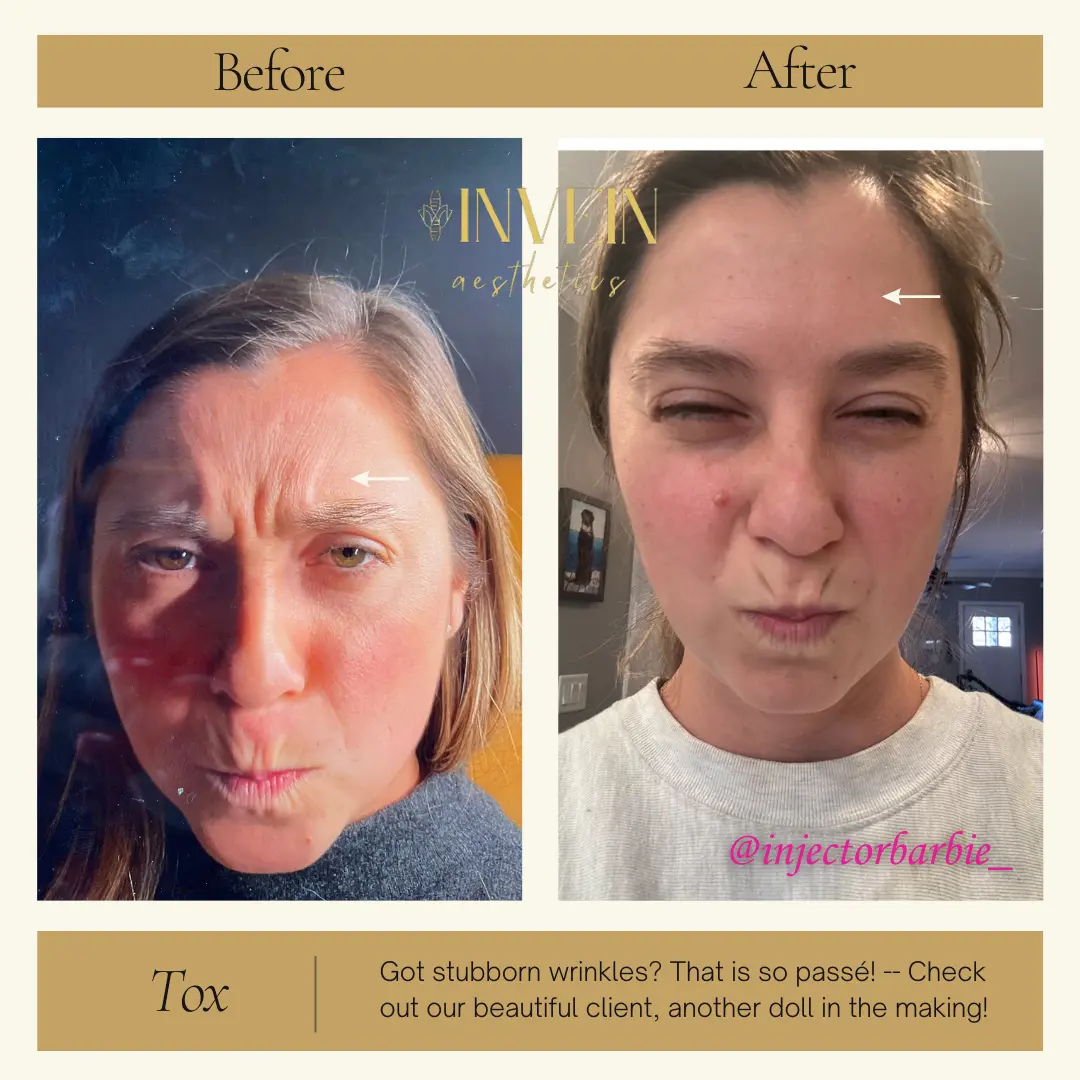 Before and After | Wrinkle Treatment by Invein Aesthetics in Baltimore MD