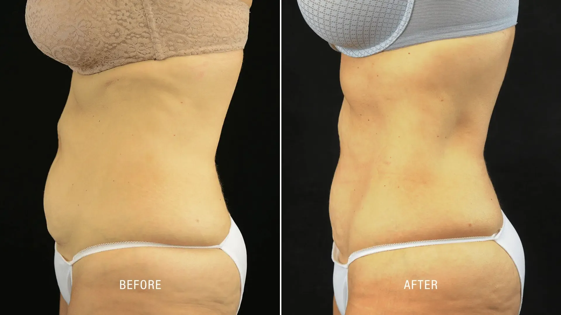 Laser Before and After_ (1)