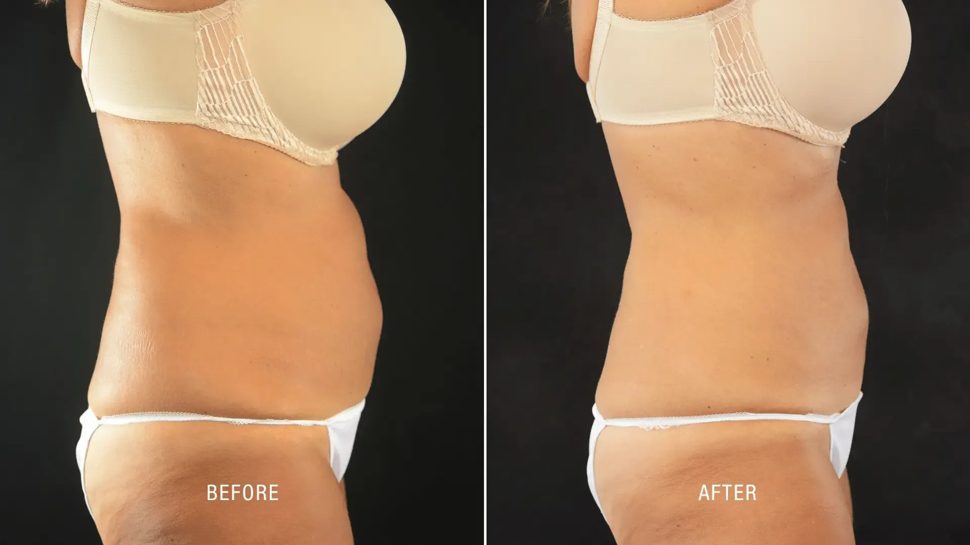 Laser Before and After_ (11)