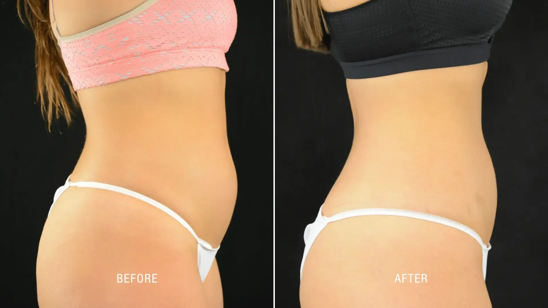 Laser Before and After_ (12)