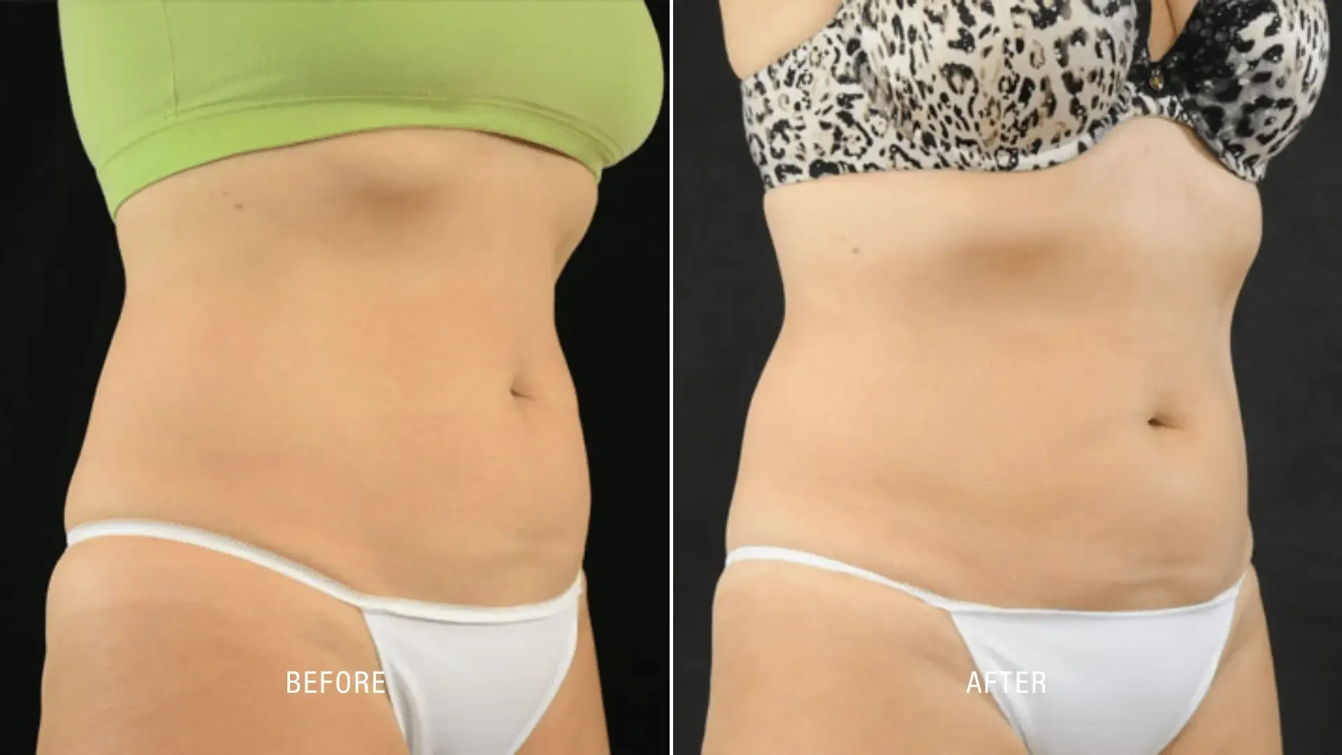 Laser Before and After_ (13)