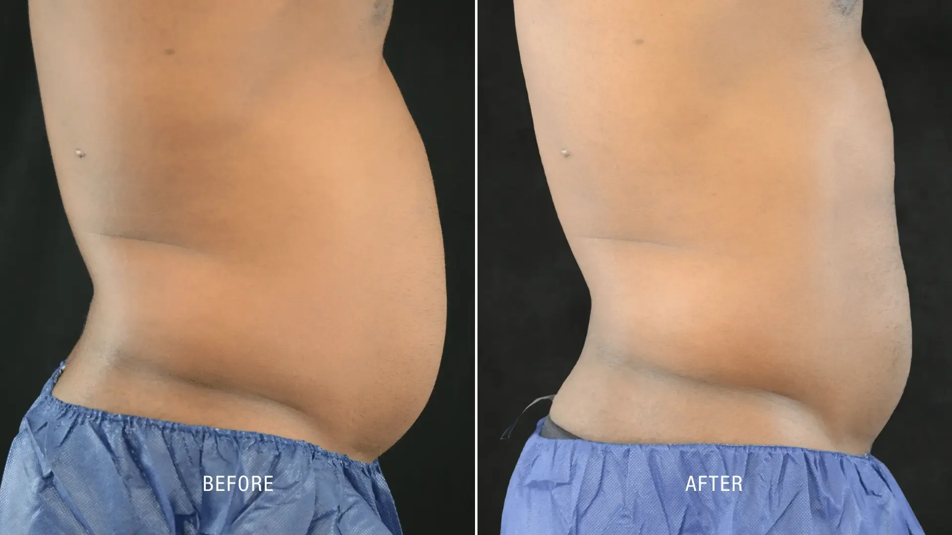 Laser Before and After_ (14)