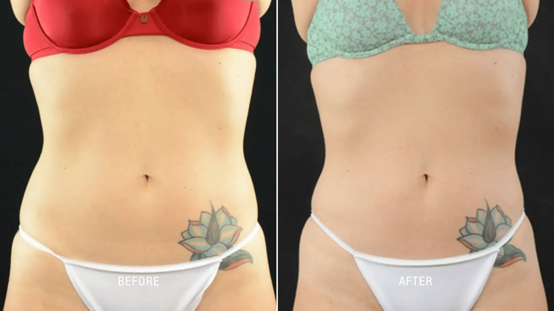Laser Before and After_ (4)
