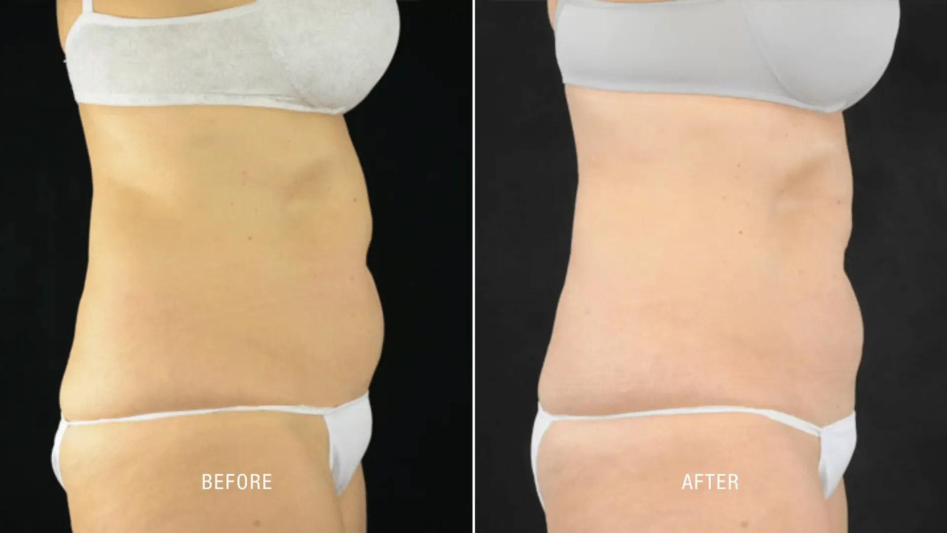 Laser Before and After_ (5)