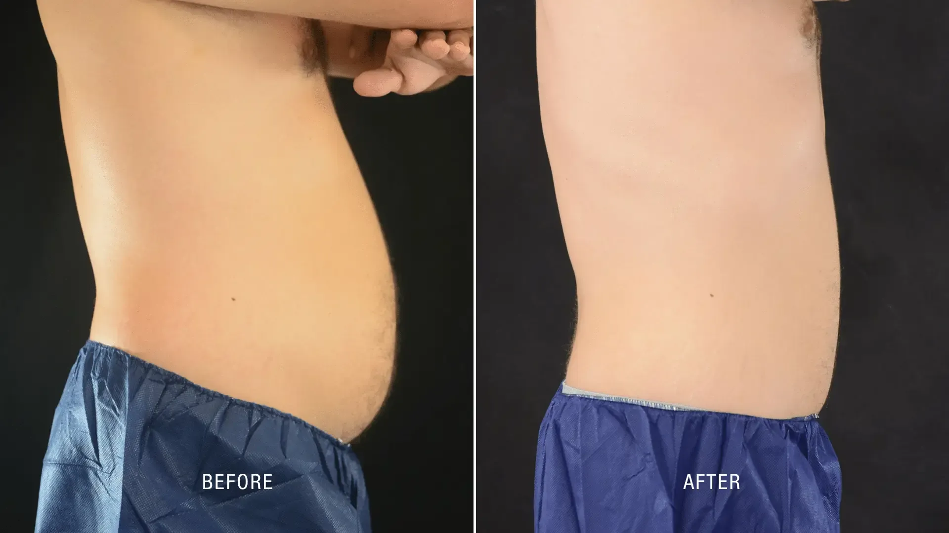 Laser Before and After_ (8)