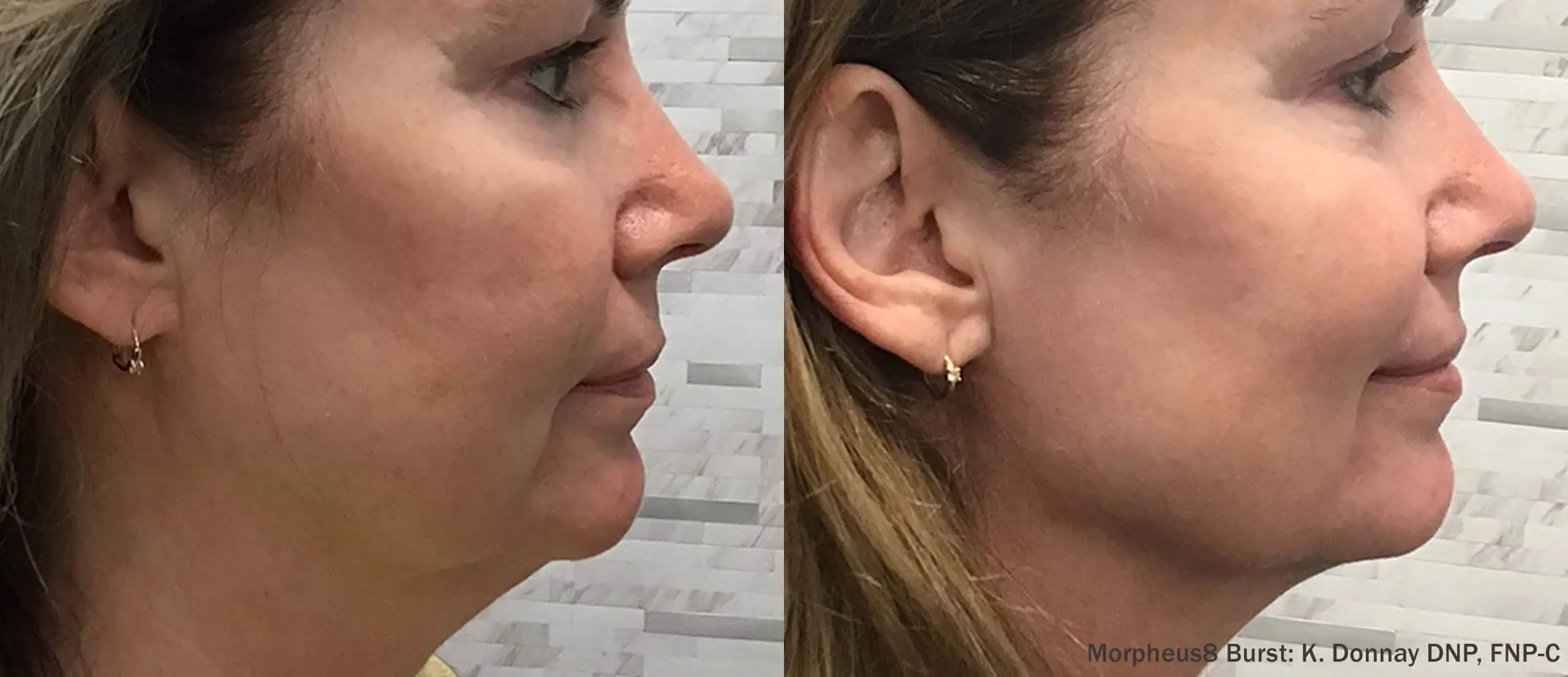 Microneedling With RF-before-&-after (1)