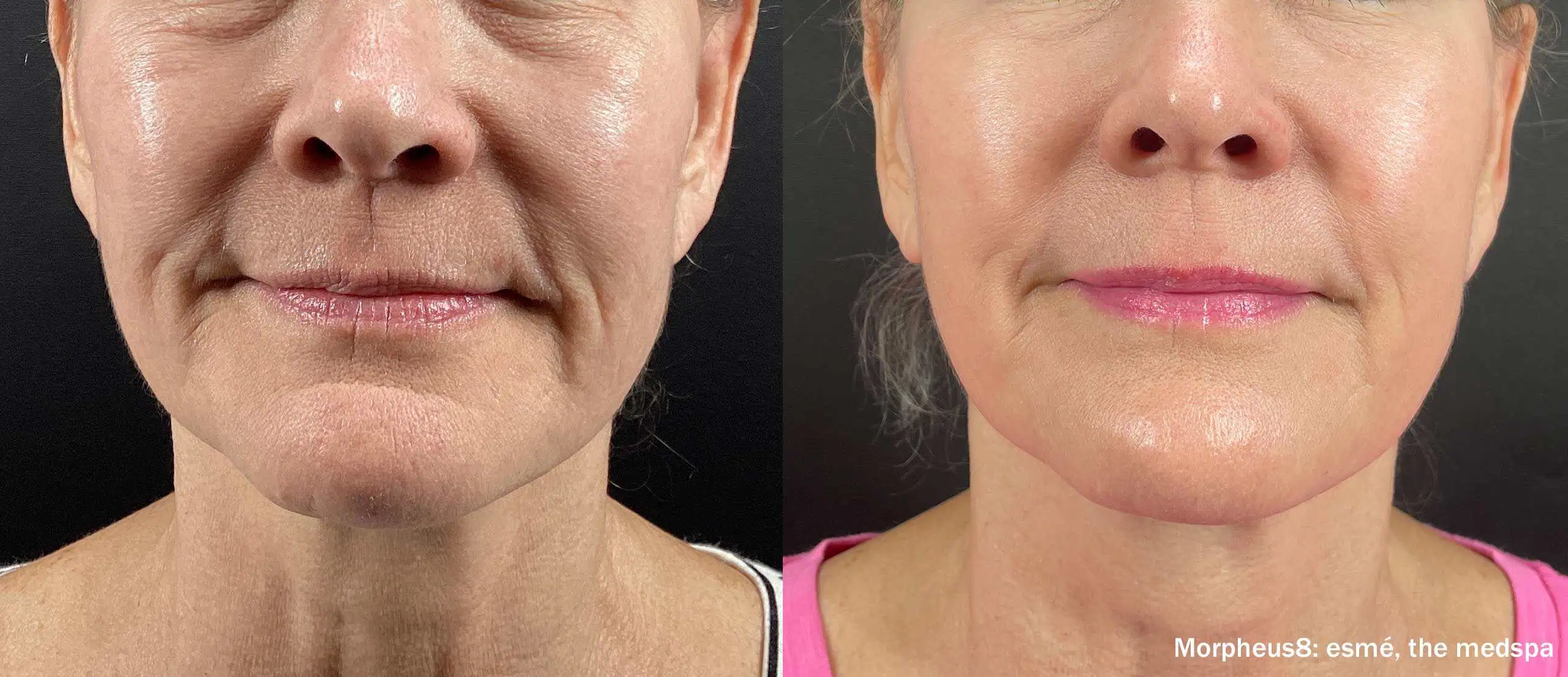 Microneedling With RF-before-&-after2