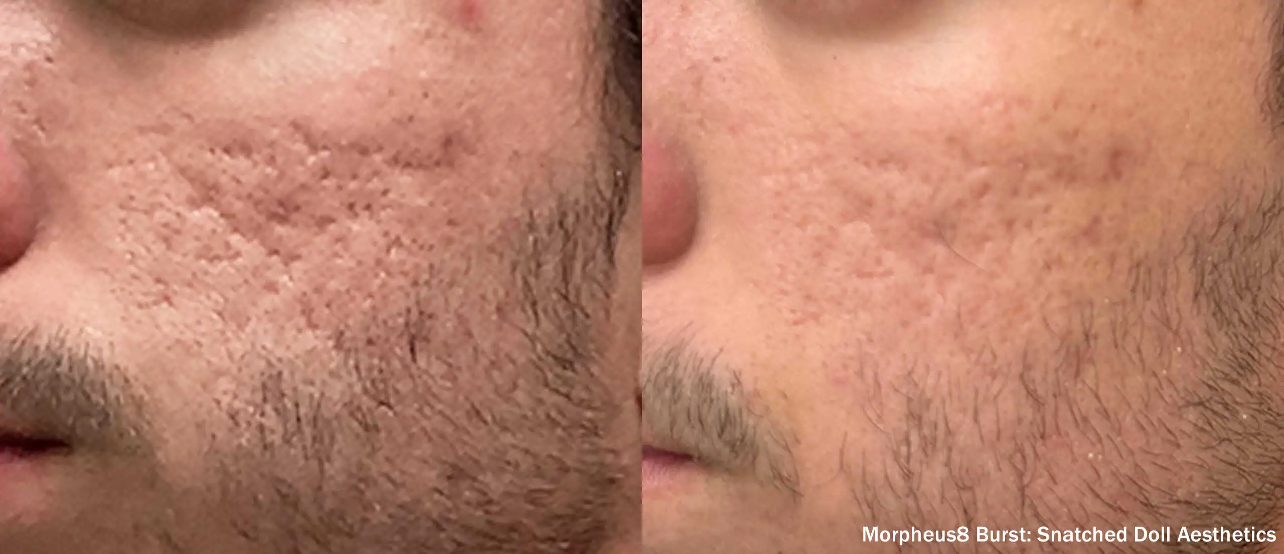 Microneedling With RF-before-&-after4
