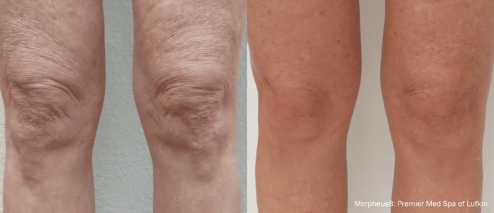 Microneedling with RF Body-before & after