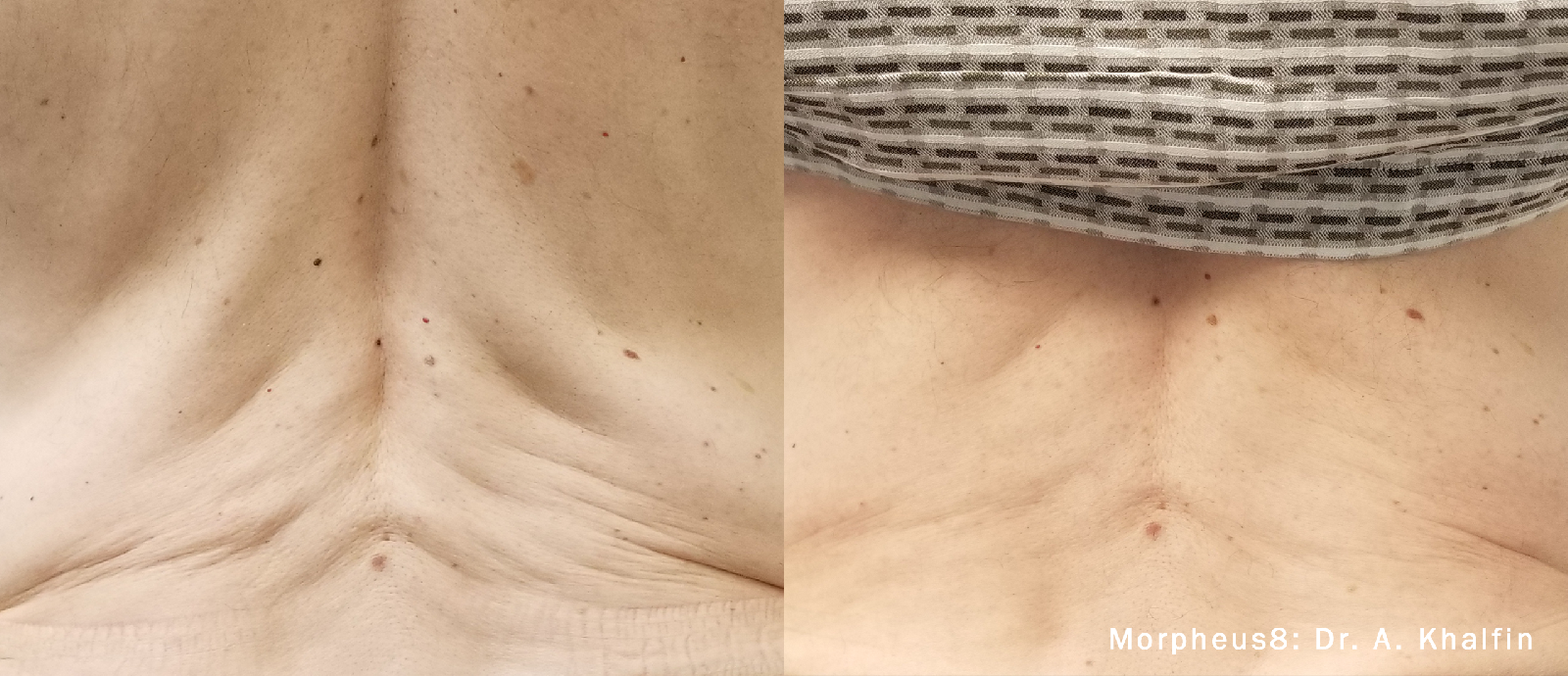 Microneedling with RF Body-before & after2
