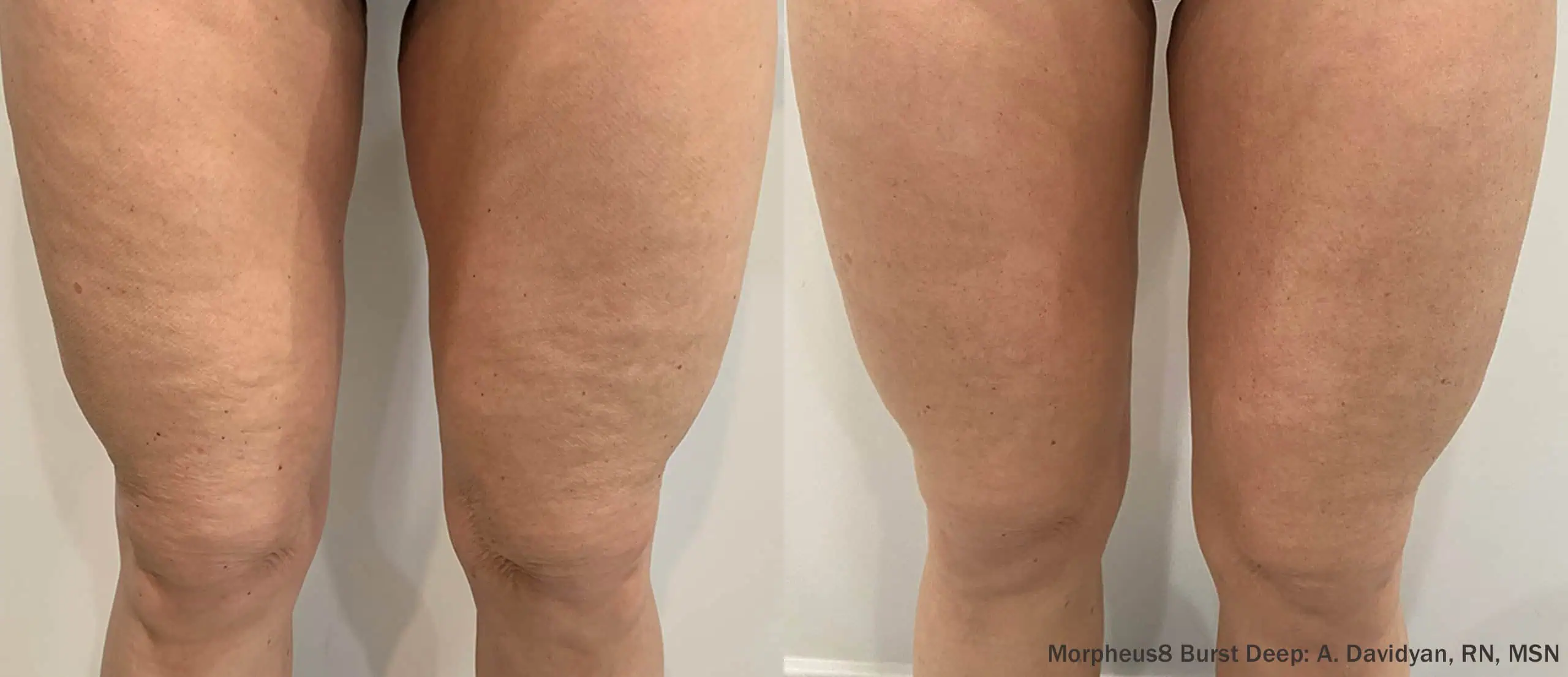 Microneedling with RF Body-before & after4