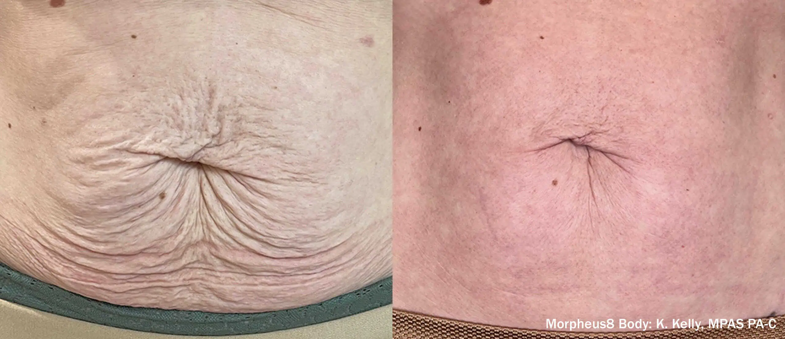 Microneedling with RF Body-before & after5