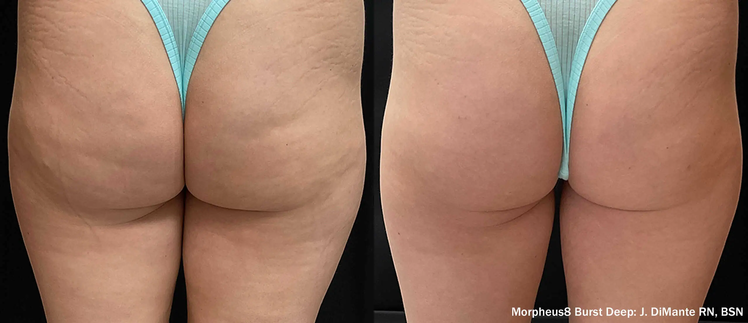 Microneedling with RF Body-before & after6
