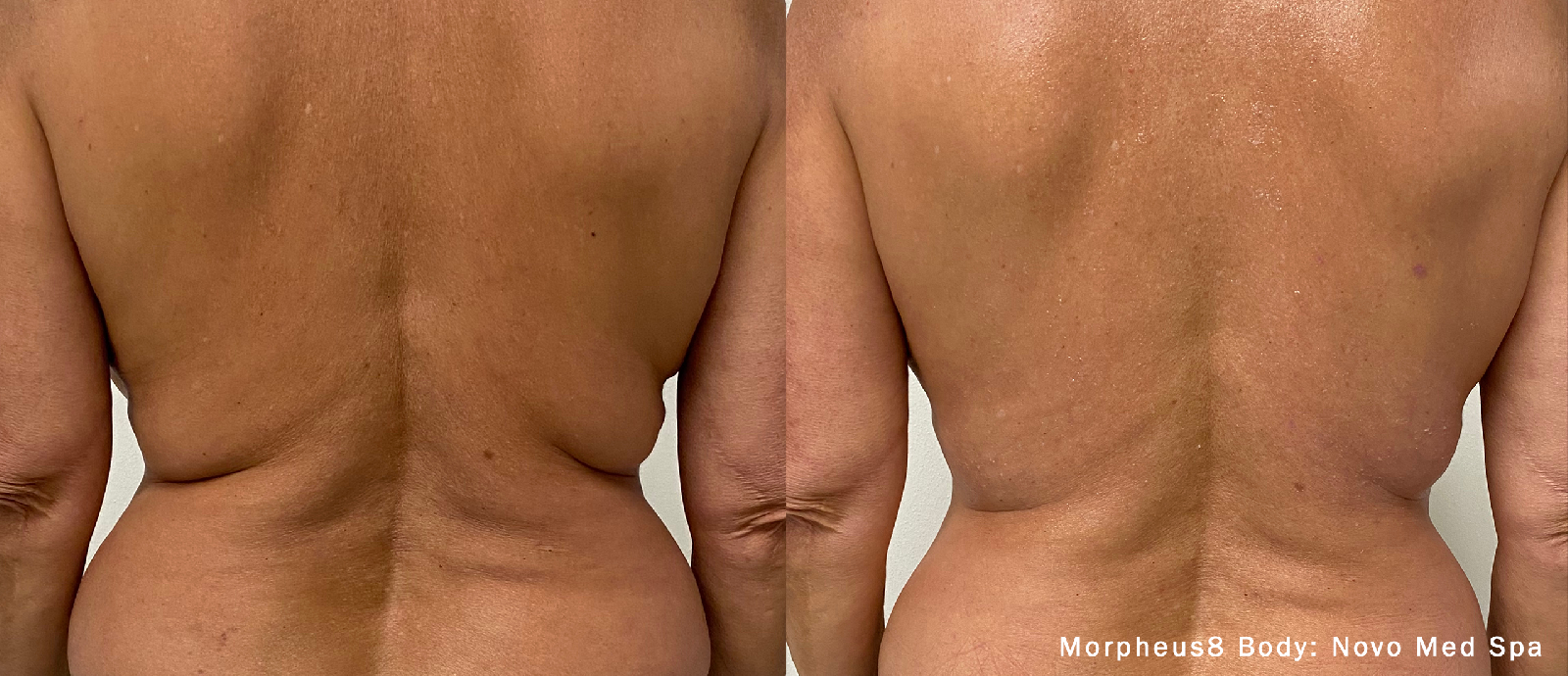 Microneedling with RF Body-before & after7