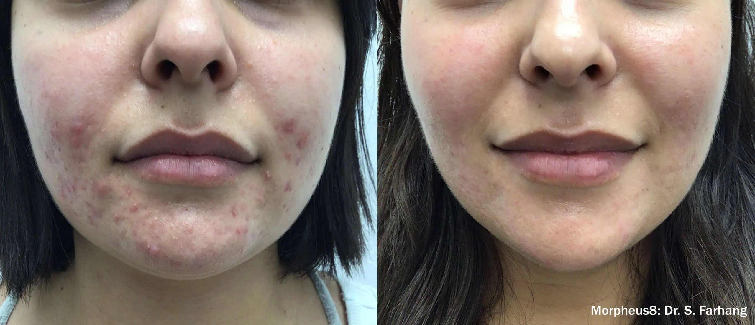 Microneedling with RF-before & after
