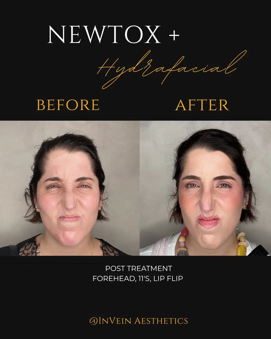 Alana Berk tox facial angry face