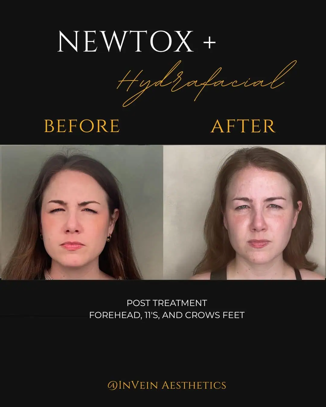 Copy of Copy of Tess Roper Jeuveau BeforeAfter Side Profile