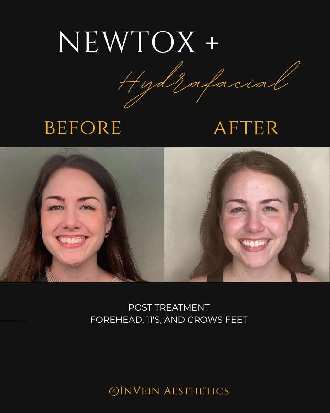 Copy of Tess Roper Jeuveau BeforeAfter Side Profile (1)