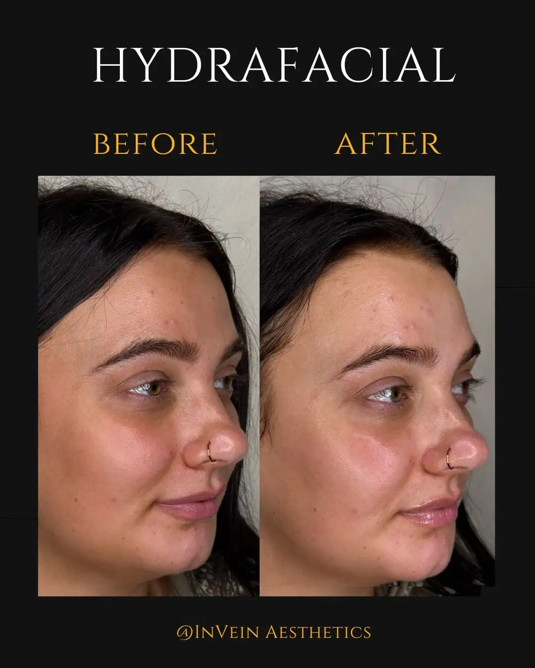 Hydrafacial Before and After (1)
