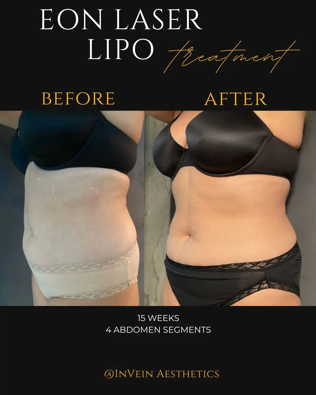 _Katherine EON Before and After (Side Profile)