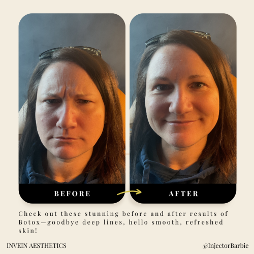 Botox treatment for smooth skin | before and after | InVein Aesthetics | Baltimore, MD
