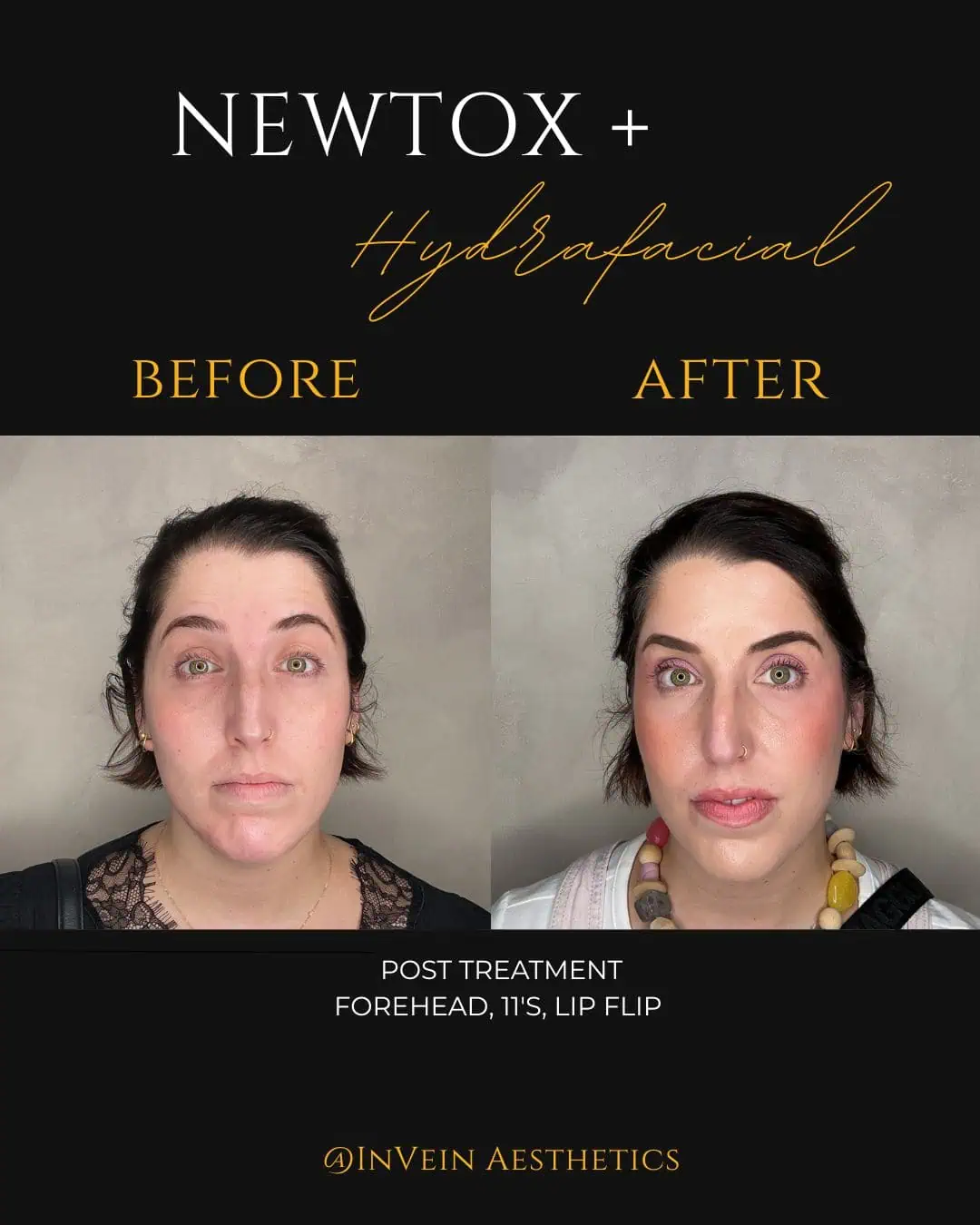 Alana Berk tox facial surprised face