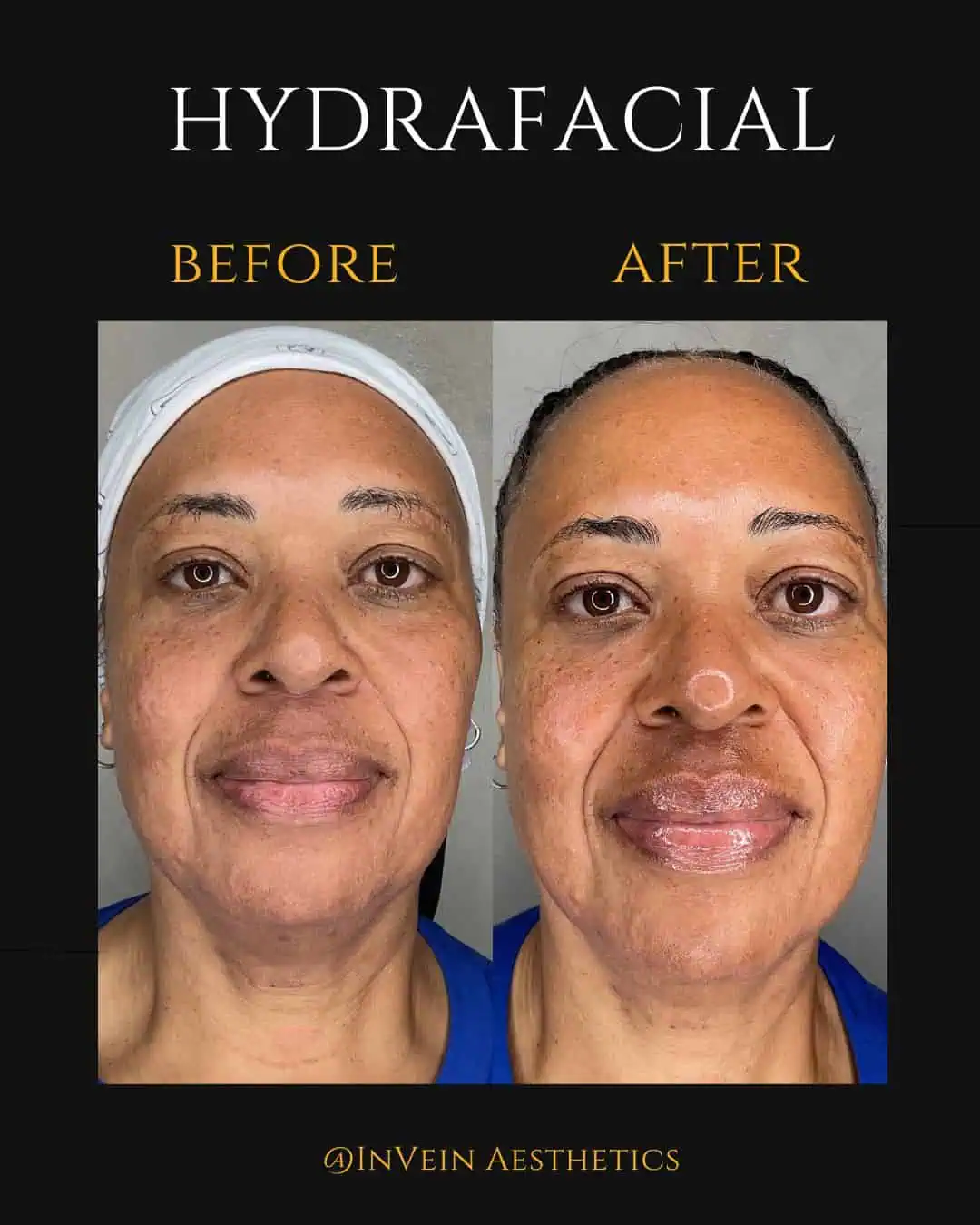 Hydrafacial Before and After (1) (1)