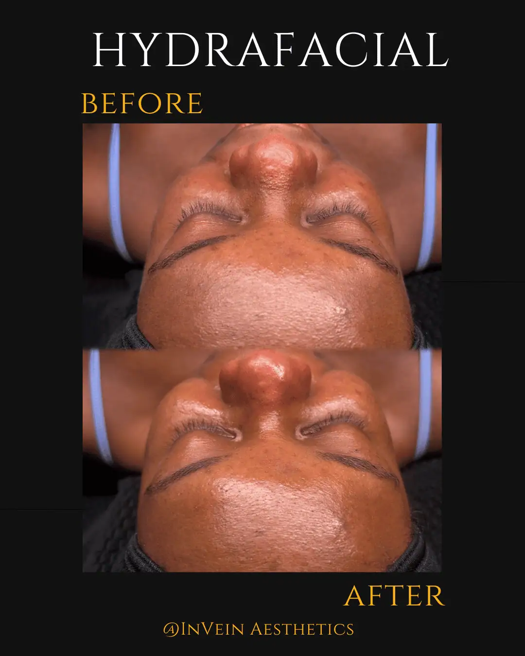 Hydrafacial Before and After